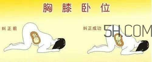 什么情况下需要剖腹产 剖腹产最全科普