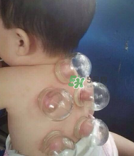 拔火罐后颜色多久消失？拔火罐印子多久能消除？