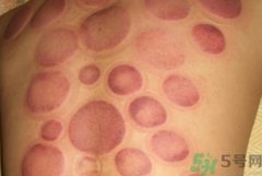 拔火罐可以减肥吗?拔火罐能减肥吗?