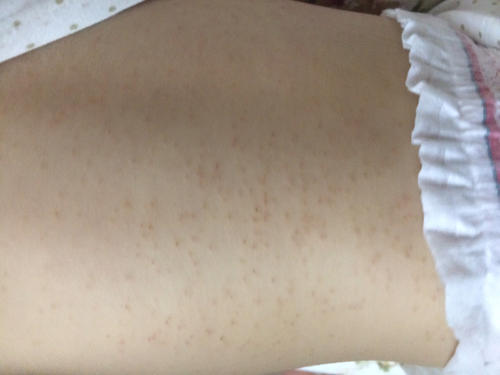 湿疹饮食要注意什么 湿疹不能吃什么